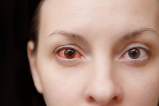 Causes and Treatments of Pink Eye